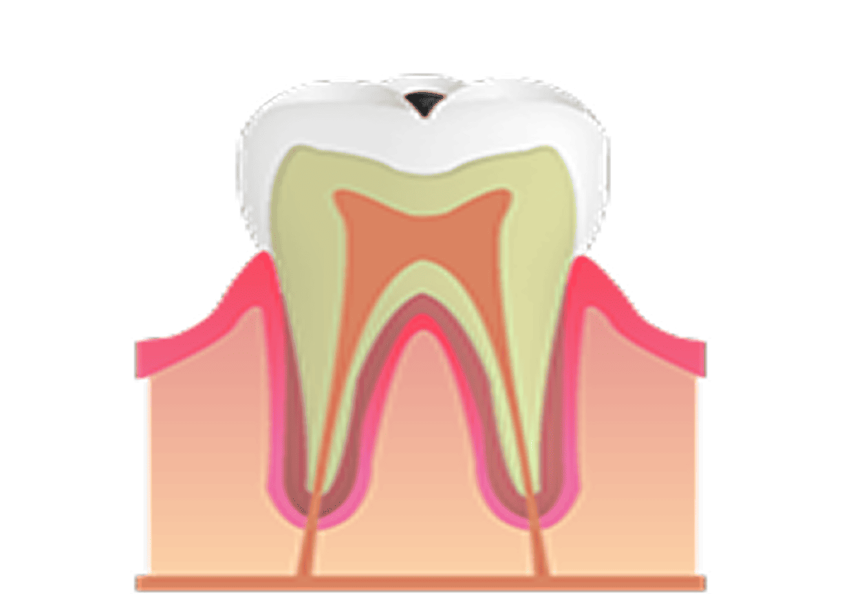 初期むし歯(C1)の治療