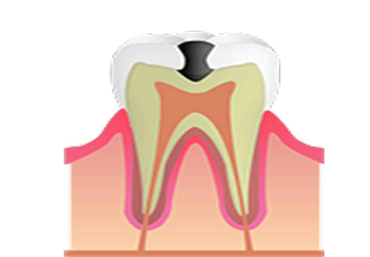 中等度むし歯(C2)の治療