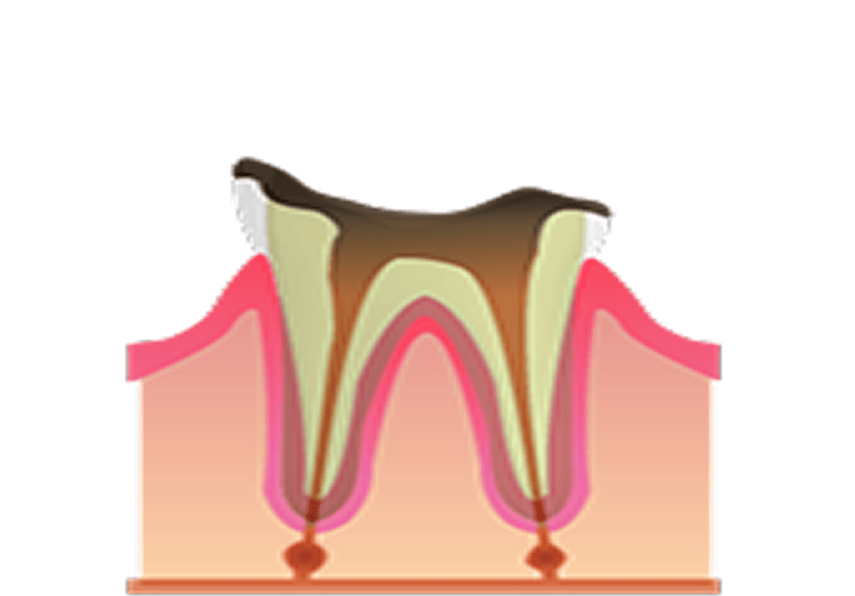 重度むし歯(C3〜C4)の治療