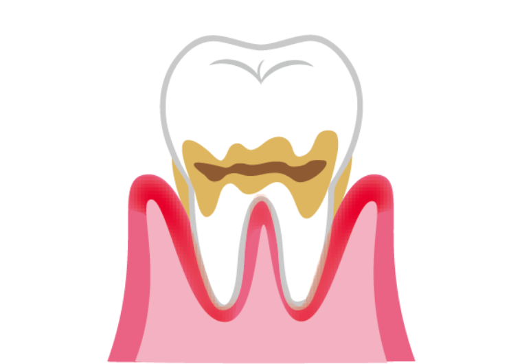 初期歯周炎